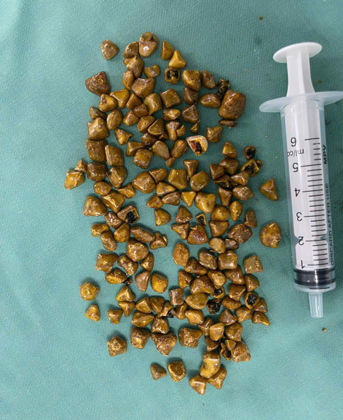 Người phụ nữ 39 tuổi đau bụng dữ dội, b&aacute;c sĩ gắp ra thứ "đ&aacute;ng sợ" trong ổ bụng - Ảnh 2.