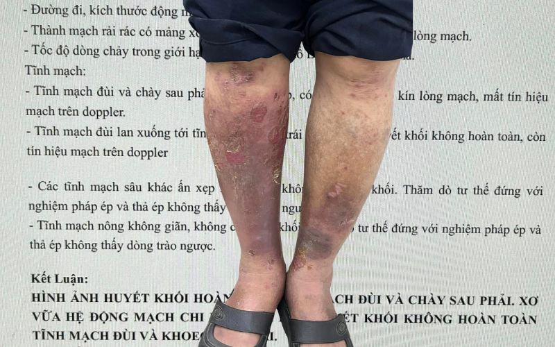 Nghi&ecirc;n cứu tr&ecirc;n 930.000 người t&igrave;m ra 1 loại vi khuẩn l&agrave; t&aacute;c nh&acirc;n g&acirc;y ung thư, ti&ecirc;u diệt sớm giảm 34% nguy cơ ung thư đại trực tr&agrave;ng - Ảnh 2.
