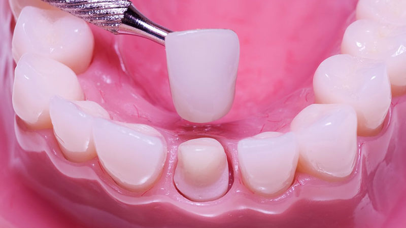 V&igrave; sao nhiều người bọc răng sứ xong bị h&ocirc;i miệng? - Ảnh 1.