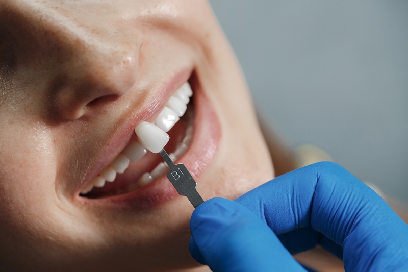 V&igrave; sao nhiều người bọc răng sứ xong bị h&ocirc;i miệng? - Ảnh 3.