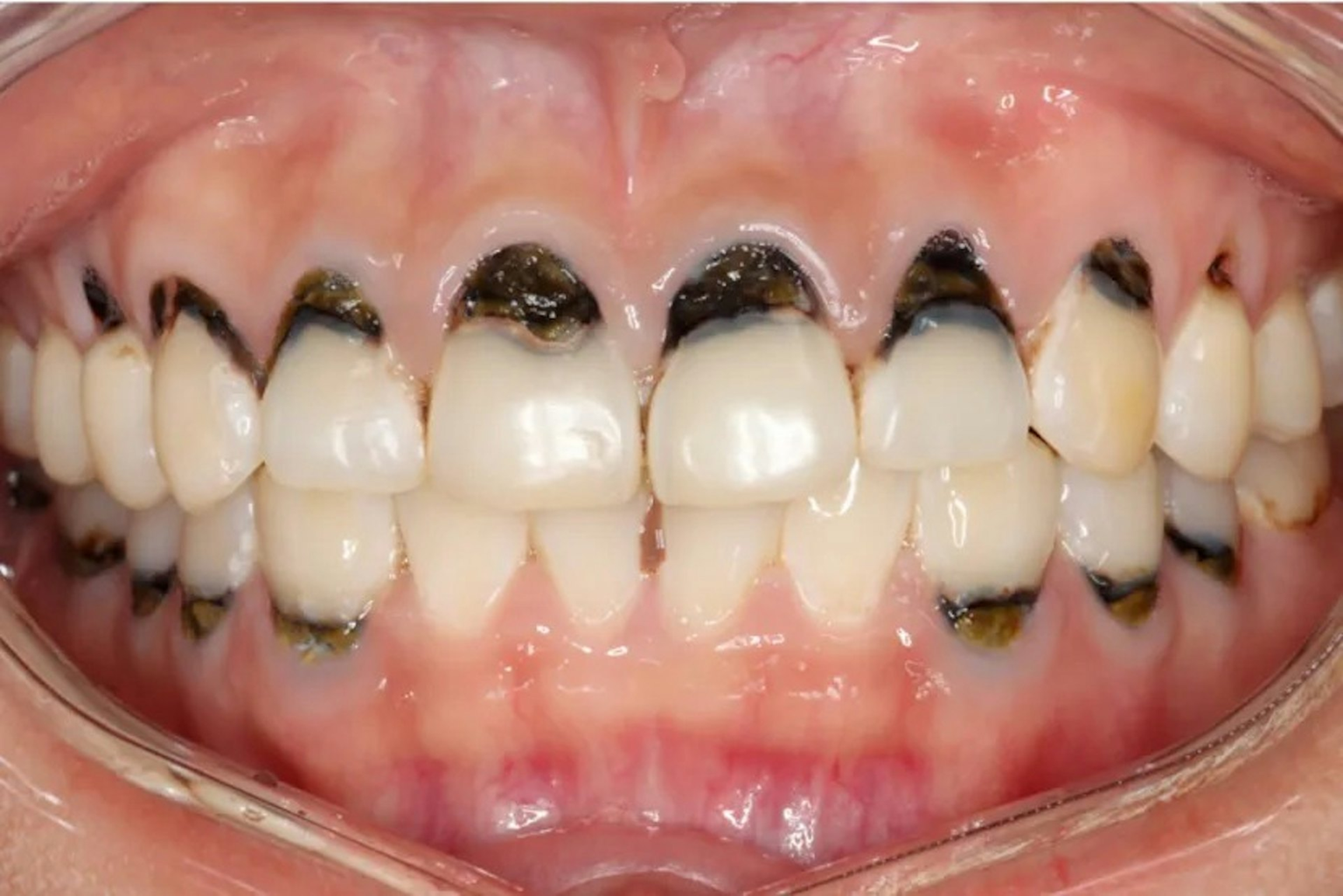 Người phụ nữ 30 tuổi cả h&agrave;m ch&acirc;n răng đen s&igrave;, m&ugrave;i h&ocirc;i nồng nặc v&igrave; 1 loại nước vạn người m&ecirc;- Ảnh 2.
