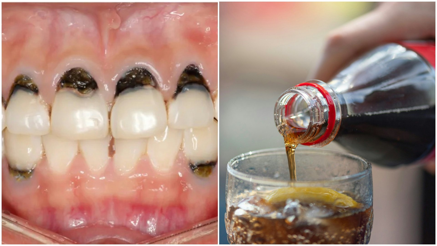 Người phụ nữ 30 tuổi cả h&agrave;m ch&acirc;n răng đen s&igrave;, m&ugrave;i h&ocirc;i nồng nặc v&igrave; 1 loại nước vạn người m&ecirc;- Ảnh 1.
