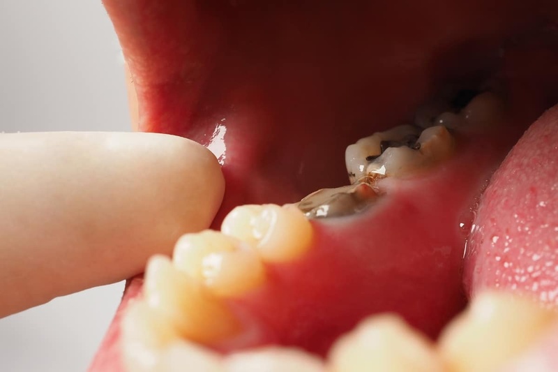 V&igrave; sao nhiều người mất răng nhưng kh&ocirc;ng chịu trồng?- Ảnh 2.