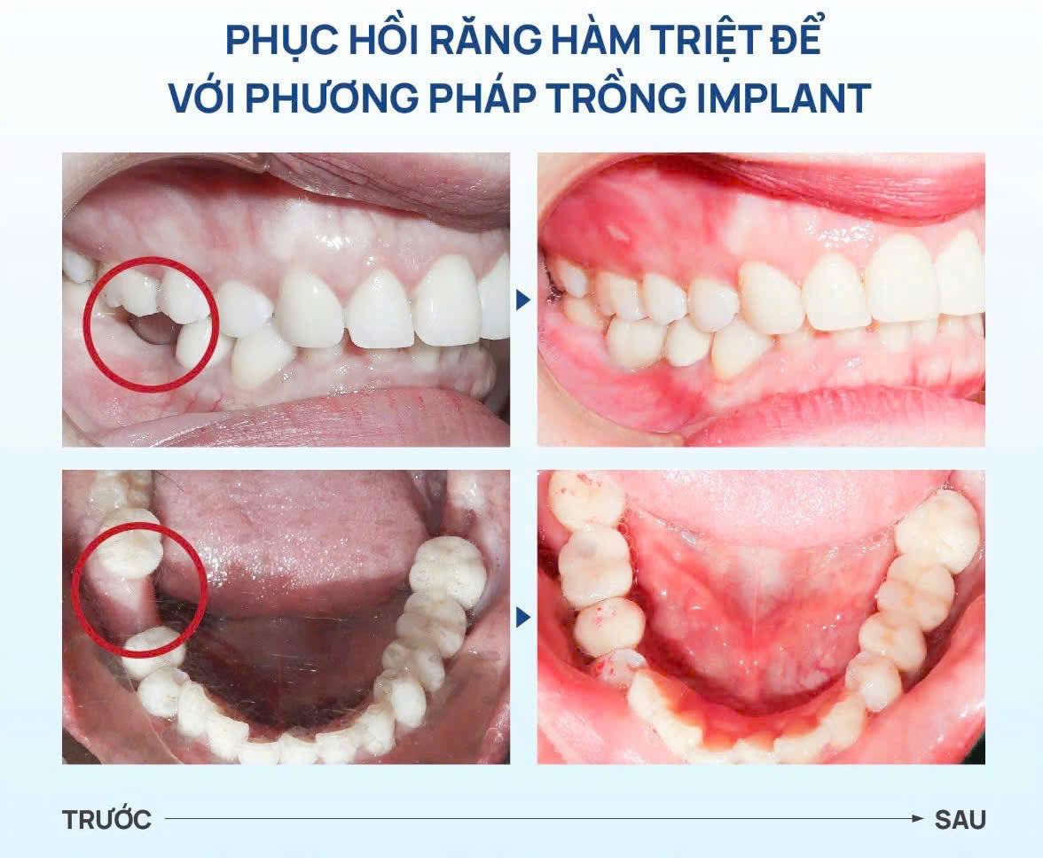 V&igrave; sao nhiều người mất răng nhưng kh&ocirc;ng chịu trồng?- Ảnh 4.