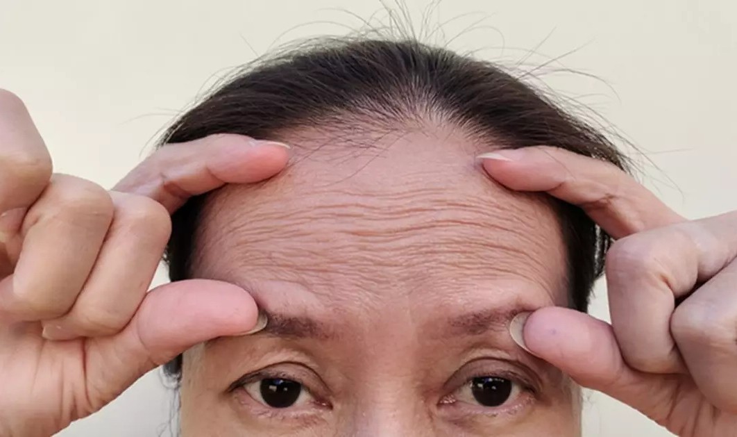 B&aacute;c sĩ n&oacute;i thẳng: 7 đặc điểm tr&ecirc;n mặt l&agrave; dấu hiệu bệnh tật, ung thư, thật tệ khi nhiều người tưởng "điềm l&agrave;nh" - Ảnh 2.