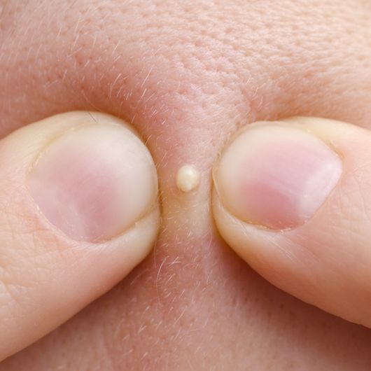 V&igrave; sao nặn mụn hay ngo&aacute;y tai lại mang lại cảm gi&aacute;c sướng kỳ lạ đến thế?  - Ảnh 1.