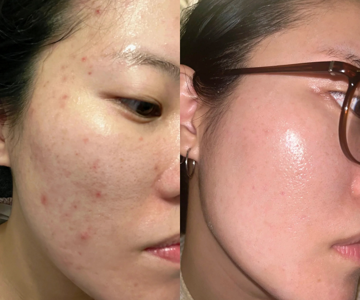Da mẩn đỏ, lỗ ch&acirc;n l&ocirc;ng to cải thiện r&otilde; rệt nhờ routine skincare chỉ vỏn vẹn 4 bước- Ảnh 2.