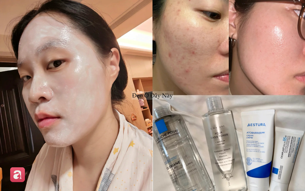 Da mẩn đỏ, lỗ ch&acirc;n l&ocirc;ng to cải thiện r&otilde; rệt nhờ routine skincare chỉ vỏn vẹn 4 bước- Ảnh 1.