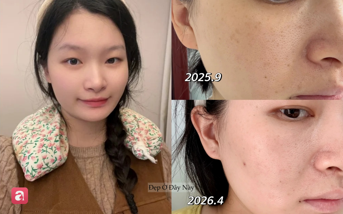 Từng khổ sở v&igrave; n&aacute;m sau sinh, t&ocirc;i t&igrave;m lại l&agrave;n da s&aacute;ng khỏe nhờ 3 bước chăm s&oacute;c đơn giản- Ảnh 1.