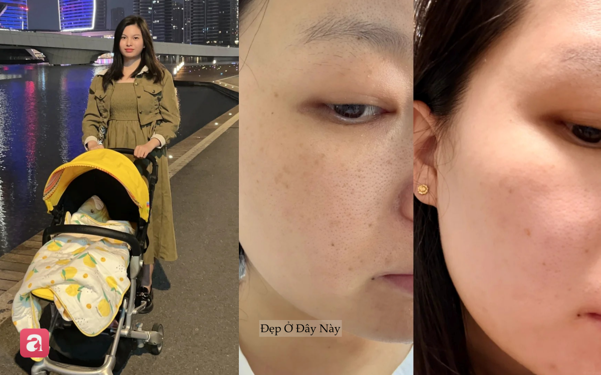 Từng khổ sở v&igrave; n&aacute;m sau sinh, t&ocirc;i t&igrave;m lại l&agrave;n da s&aacute;ng khỏe nhờ 3 bước chăm s&oacute;c đơn giản- Ảnh 2.