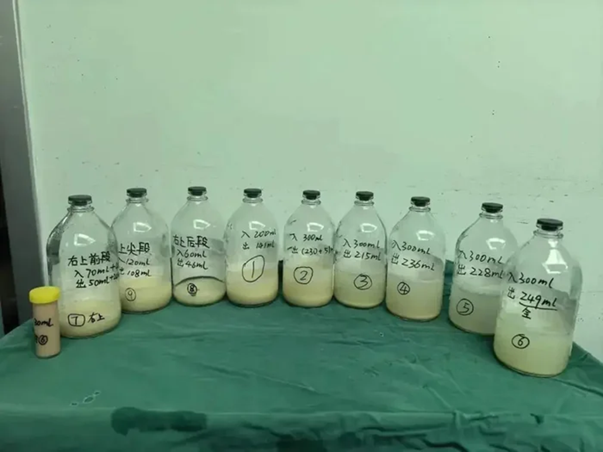 B&eacute; g&aacute;i 6 tuổi ho suốt 2 th&aacute;ng, b&aacute;c sĩ lấy thứ "đ&aacute;ng sợ" lấp đầy hai l&aacute; phổi - Ảnh 1.