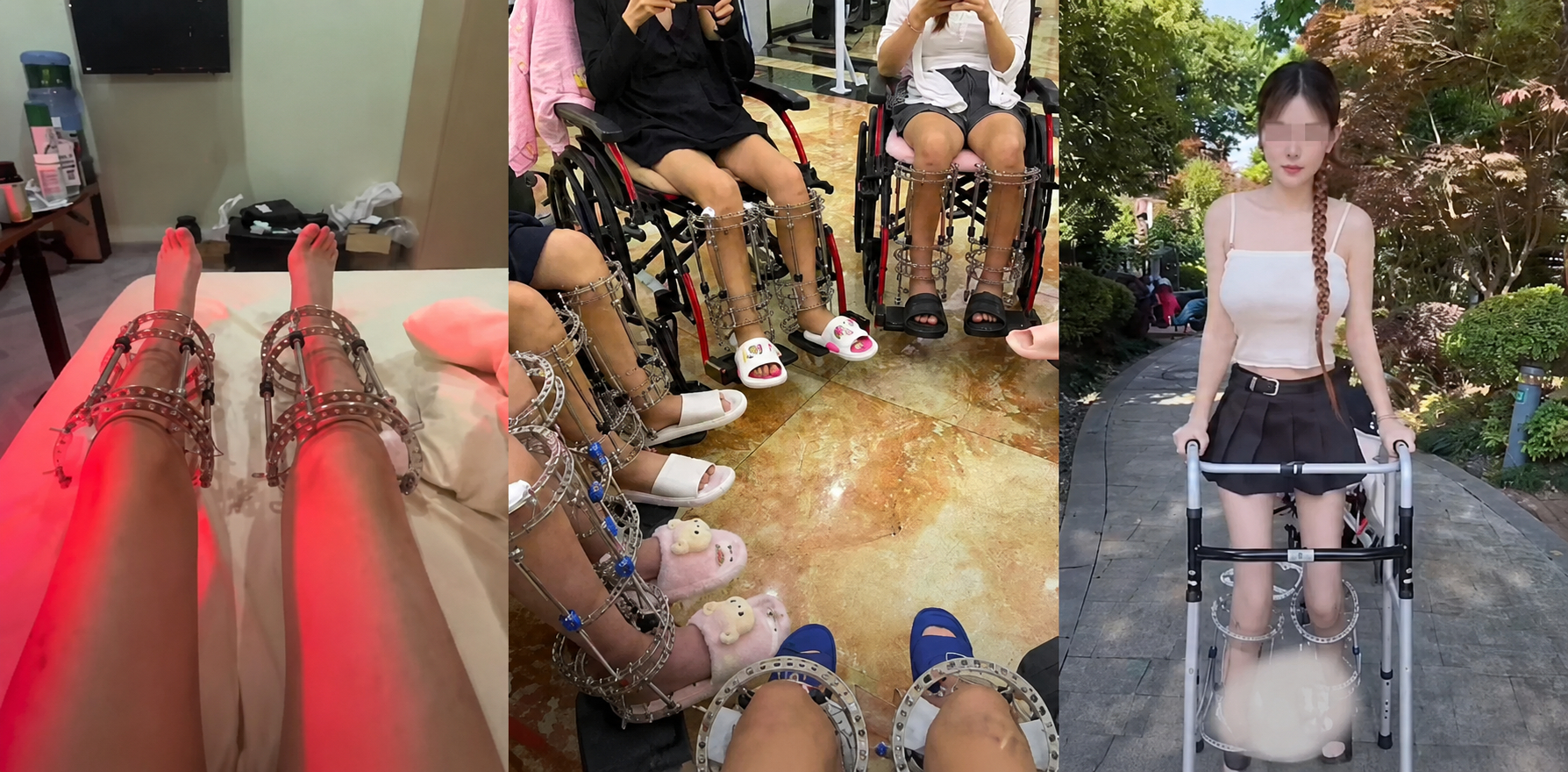 Điều tra: B&ecirc;n trong "chợ đen" phẫu thuật tăng chiều cao, hơn 1,5 tỷ đồng đổi lấy từng milim&eacute;t v&agrave; những ca mổ kh&ocirc;ng lộ mặt b&aacute;c sĩ- Ảnh 1.