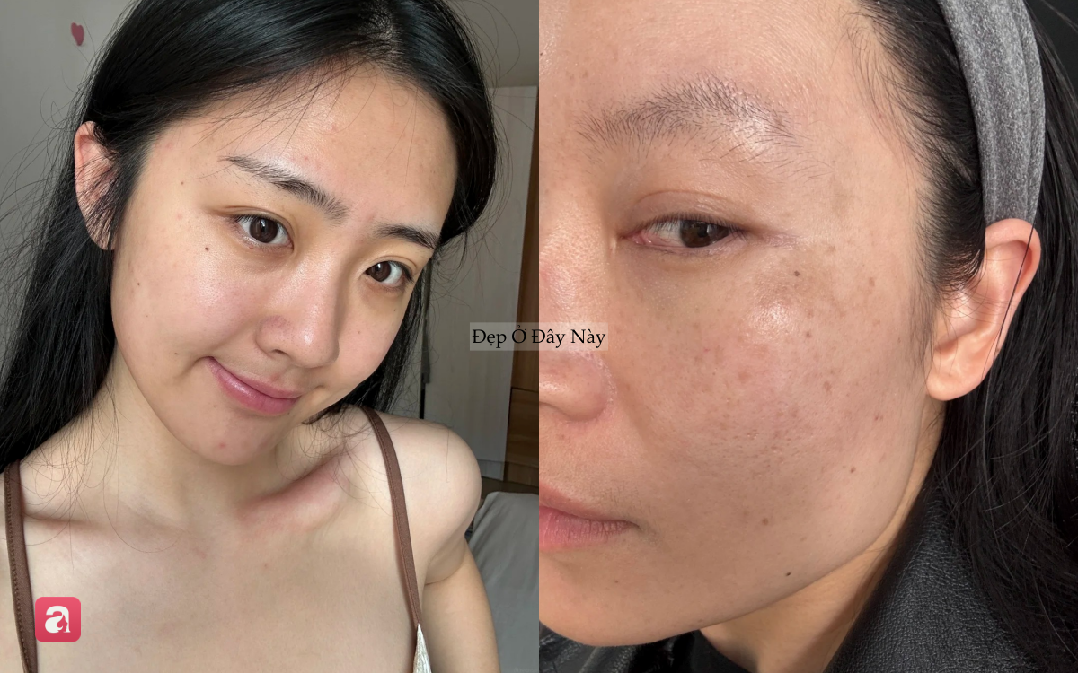 Nơi bị n&aacute;m nhiều nhất tr&ecirc;n khu&ocirc;n mặt h&oacute;a ra lại l&agrave; chỗ dễ "đập v&agrave;o mặt nhất" - Ảnh 1.