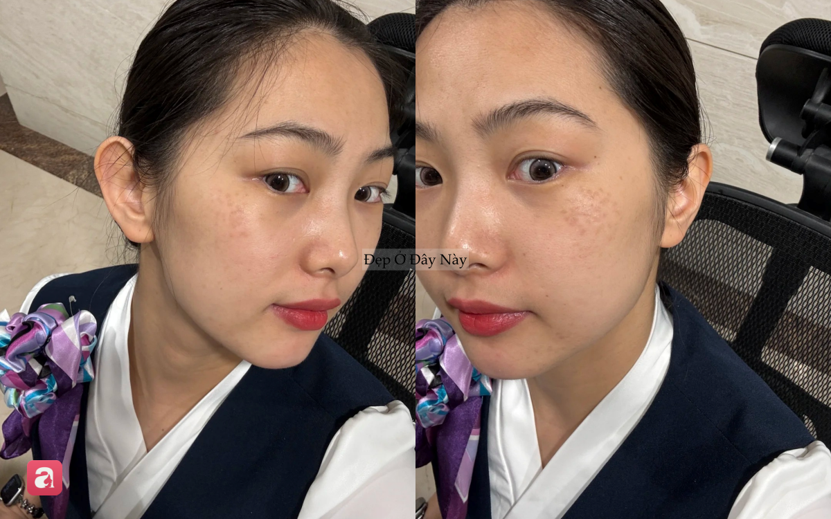 Nơi bị n&aacute;m nhiều nhất tr&ecirc;n khu&ocirc;n mặt h&oacute;a ra lại l&agrave; chỗ dễ "đập v&agrave;o mặt nhất" - Ảnh 2.