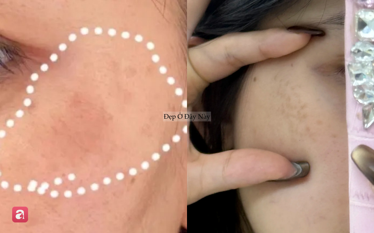 Nơi bị n&aacute;m nhiều nhất tr&ecirc;n khu&ocirc;n mặt h&oacute;a ra lại l&agrave; chỗ dễ "đập v&agrave;o mặt nhất" - Ảnh 3.