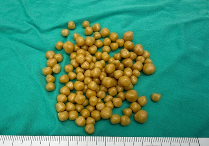 Người phụ nữ 38 tuổi đau bụng suốt 1 th&aacute;ng, đi kh&aacute;m b&aacute;c sĩ ph&aacute;t hiện &ldquo;khối u b&iacute; ẩn&rdquo; chứa 130 vi&ecirc;n sỏi tr&ocirc;ng như &ldquo;bọc trứng c&aacute;&rdquo;- Ảnh 2.