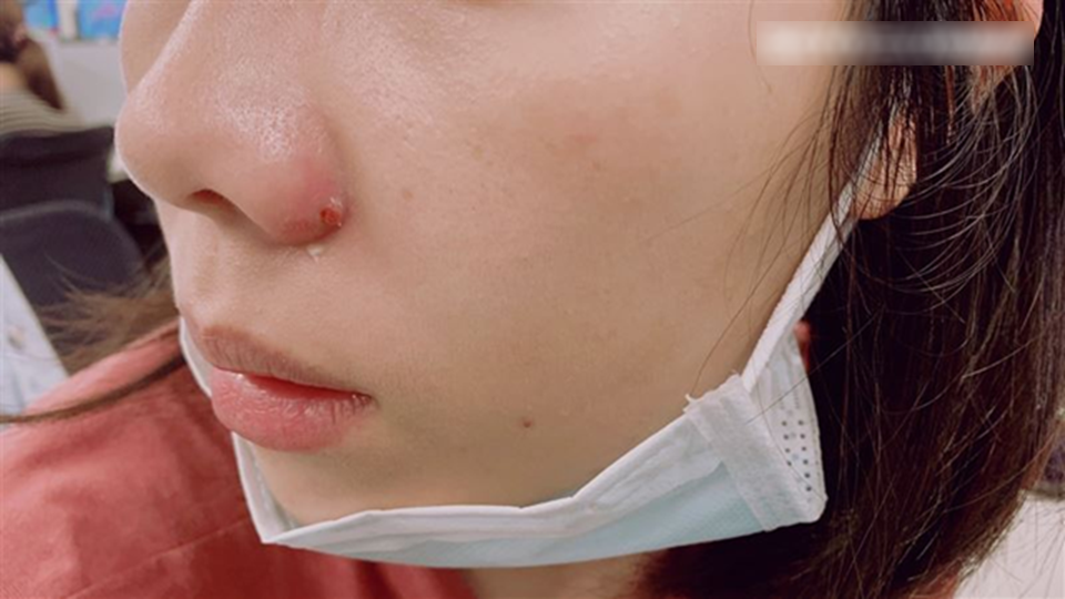 Nặn mụn quanh miệng, người phụ nữ bị sưng tấy từ m&ocirc;i l&ecirc;n tận sống mũi, b&aacute;c sĩ cảnh b&aacute;o: Sai lầm ở 1 điểm!- Ảnh 1.