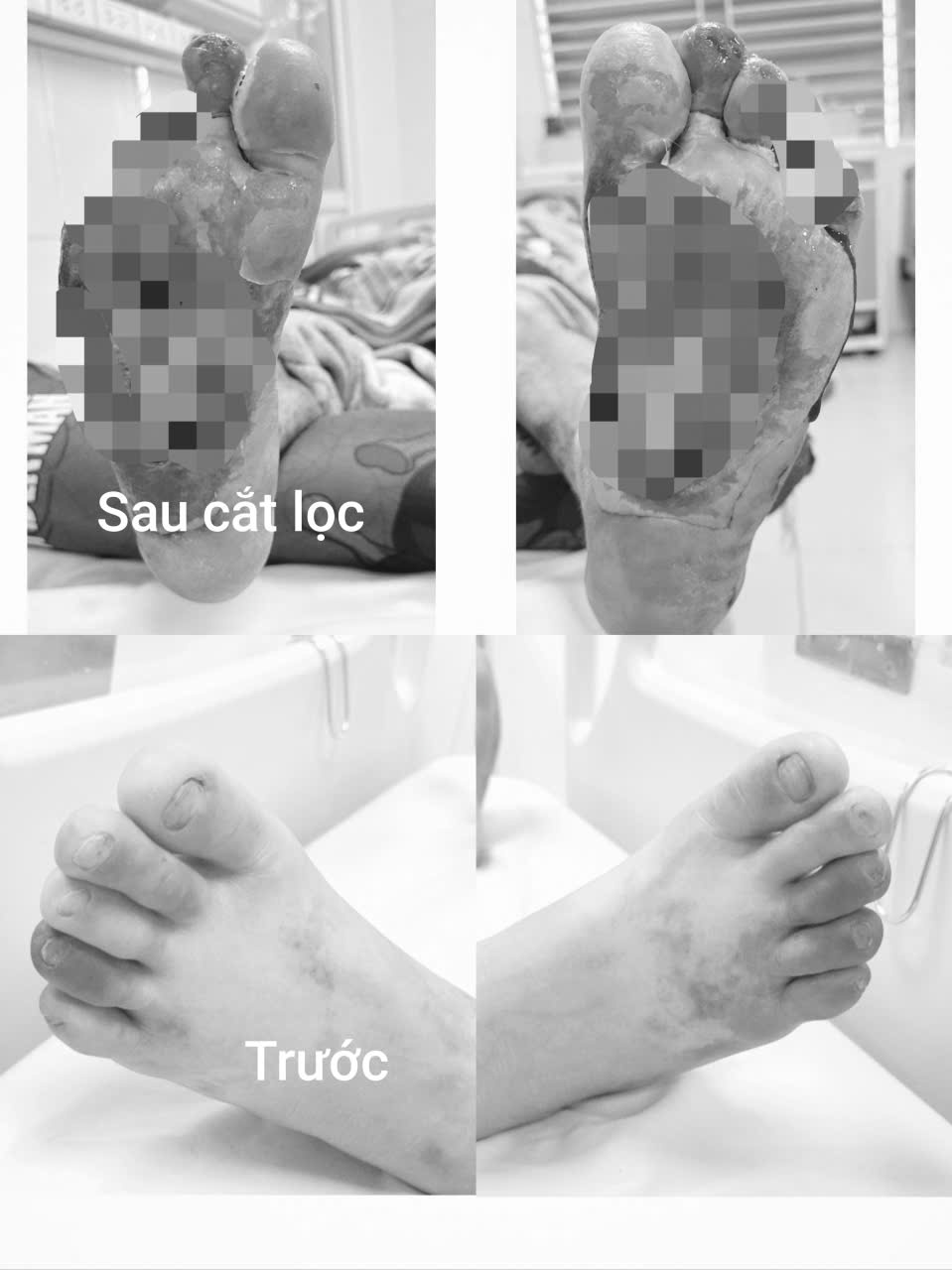 Chủ quan với vết xước nhỏ, người đ&agrave;n &ocirc;ng phải cắt cụt nhiều ng&oacute;n ch&acirc;n - Ảnh 1.