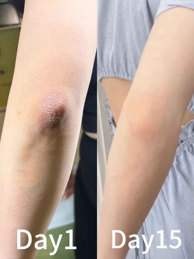 Thử &ldquo;giải cứu&rdquo; khuỷu tay th&acirc;m trong 1 tuần với 4 bước: C&oacute; một bước t&ocirc;i khuy&ecirc;n kh&ocirc;ng n&ecirc;n t&ugrave;y tiện l&agrave;m theo- Ảnh 1.