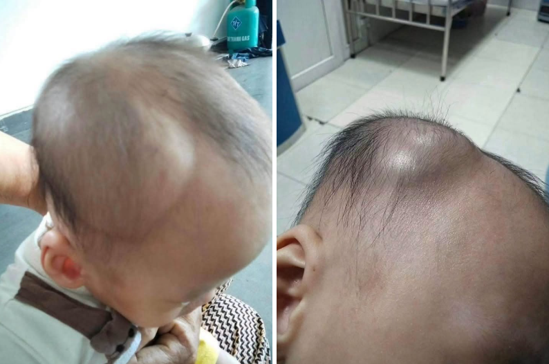 1 mẹ bỉm chia sẻ diễn biến âm thầm nhưng nguy hiểm sau cú ngã của con: Đừng chủ quan kể cả khi bé có vẻ vẫn bình thường- Ảnh 1.