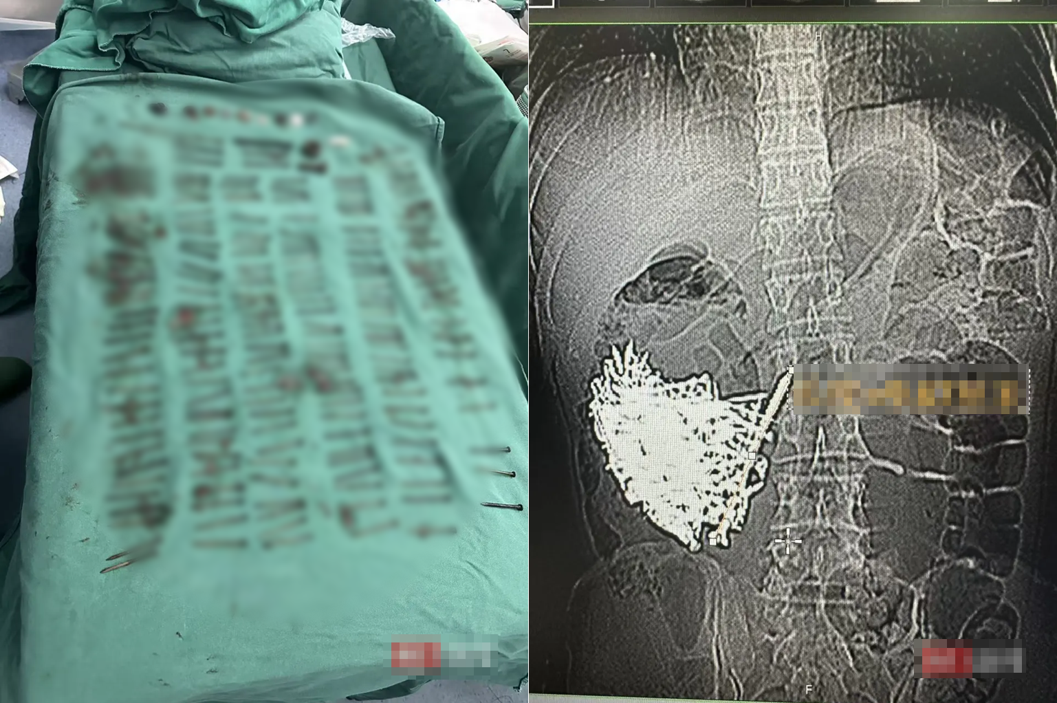 Phẫu thuật lấy ra hơn 1kg đinh sắt, đồng xu, ốc vít trong dạ dày một người đàn ông - Ảnh 1.