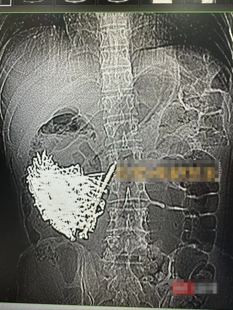 Phẫu thuật lấy ra hơn 1kg đinh sắt, đồng xu, ốc vít trong dạ dày một người đàn ông - Ảnh 2.
