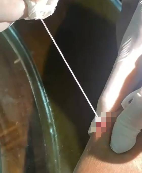 Phát hiện ca giun rồng thứ 44 tại Việt Nam: Người đàn ông ở Lào Cai có vết "mụn" ở cánh tay, nặn ra 2 đoạn giun dài tới 20cm- Ảnh 1.