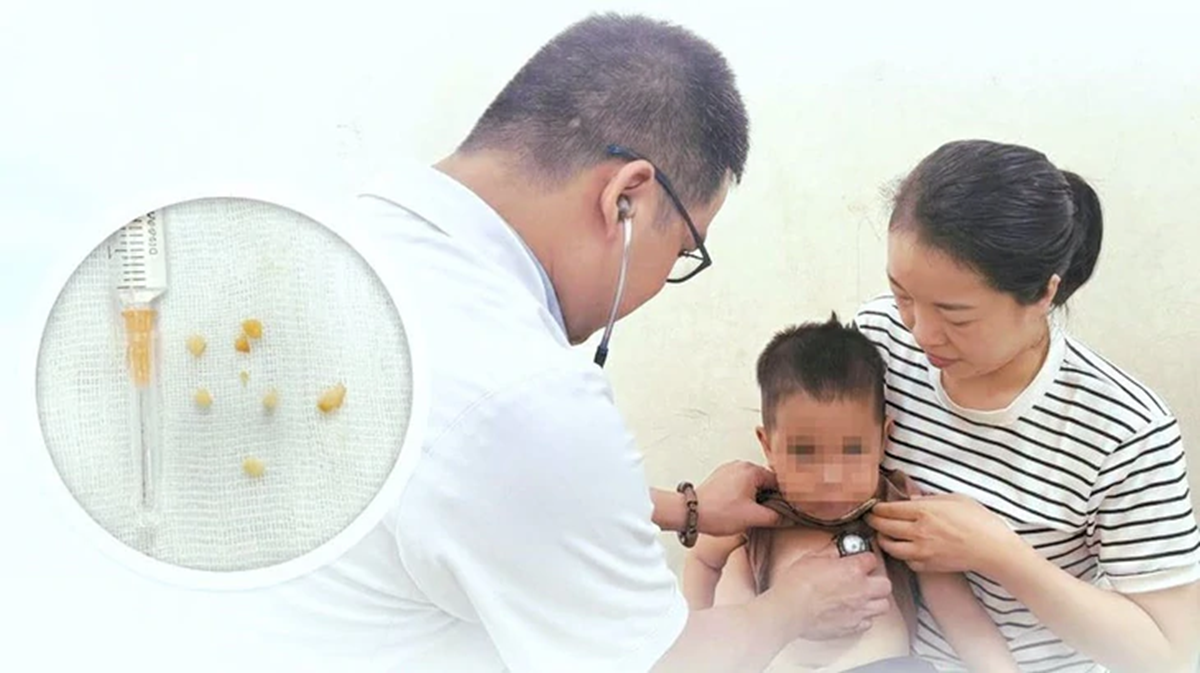 B&eacute; trai 2 tuổi ho sặc dữ dội, t&iacute;m t&aacute;i sau ăn lạc theo c&aacute;ch "vạn người m&ecirc;" - Ảnh 1.