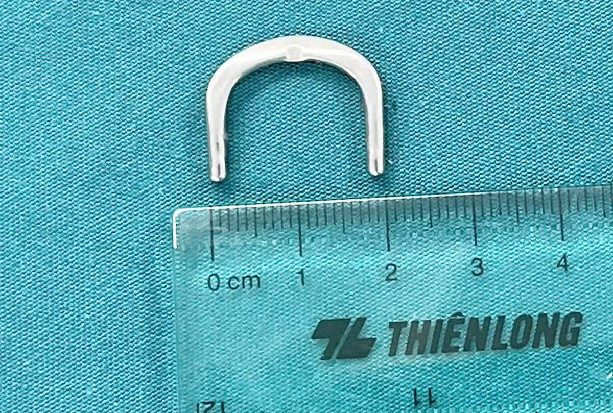 B&eacute; 3 tuổi đau bụng, b&aacute;c sĩ ph&aacute;t hiện &ldquo;vật lạ&rdquo; mắc trong t&aacute; tr&agrave;ng - Ảnh 2.