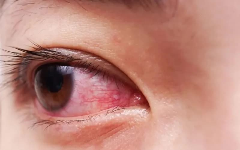 Đau mắt đỏ m&ugrave;a mưa: Chủ động ph&ograve;ng bệnh, ngăn ngừa l&acirc;y lan - Ảnh 1.