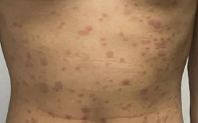 Quan hệ t&igrave;nh dục kh&ocirc;ng an to&agrave;n, nam thanh ni&ecirc;n ph&aacute;t hiện đồng nhiễm giang mai v&agrave; HIV - Ảnh 1.