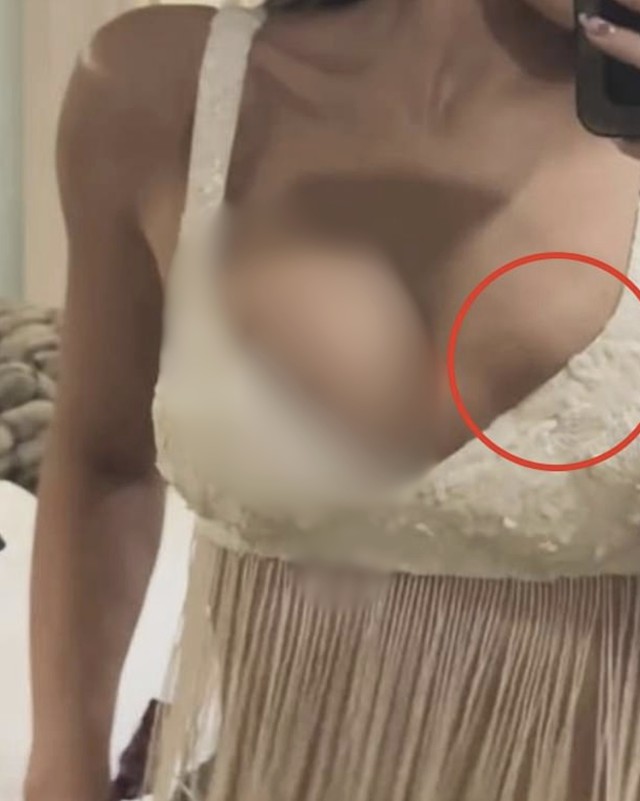 Kylie Jenner đ&ograve;i bộ ngực kh&aacute;c sau tin đồn vỡ t&uacute;i ngực v&igrave; bung xo&atilde; qu&aacute; hăng- Ảnh 4.