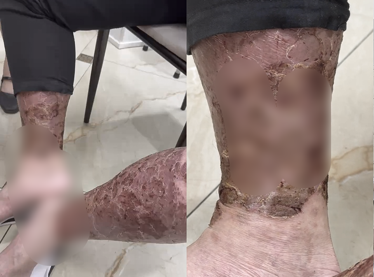 Ngứa k&eacute;o d&agrave;i khiến người bệnh lạm dụng rượu để ngủ, b&aacute;c sĩ cảnh b&aacute;o hệ lụy- Ảnh 1.
