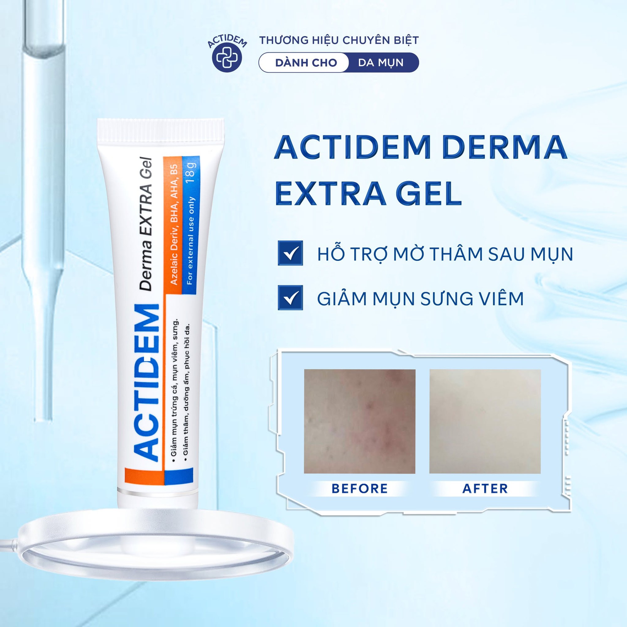 Mụn kh&ocirc;ng chỉ là c&acirc;u chuy&ecirc;̣n tu&ocirc;̉i d&acirc;̣y thì - Ảnh 3.