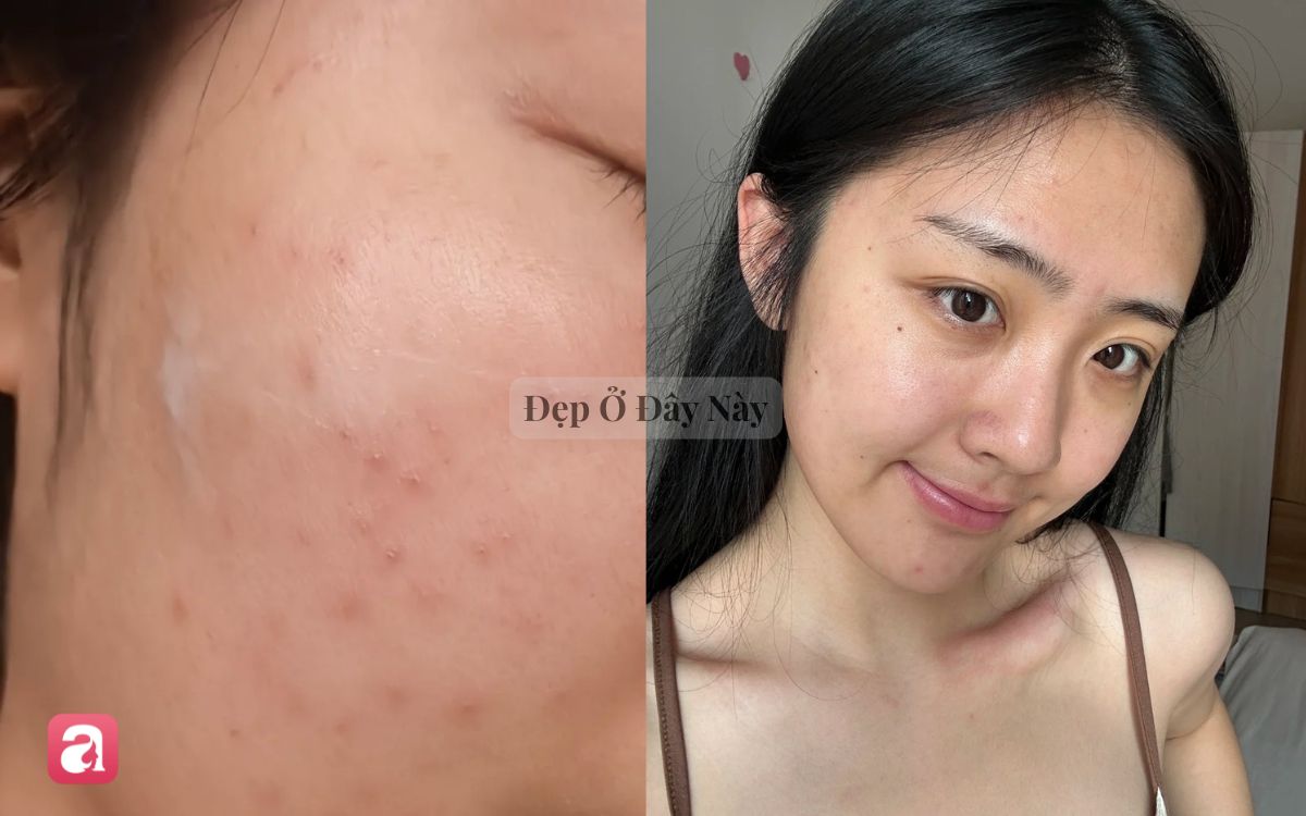 V&igrave; sao dưỡng da qu&aacute; nhiều lại c&oacute; thể khiến l&agrave;n da ng&agrave;y c&agrave;ng xấu đi?- Ảnh 1.