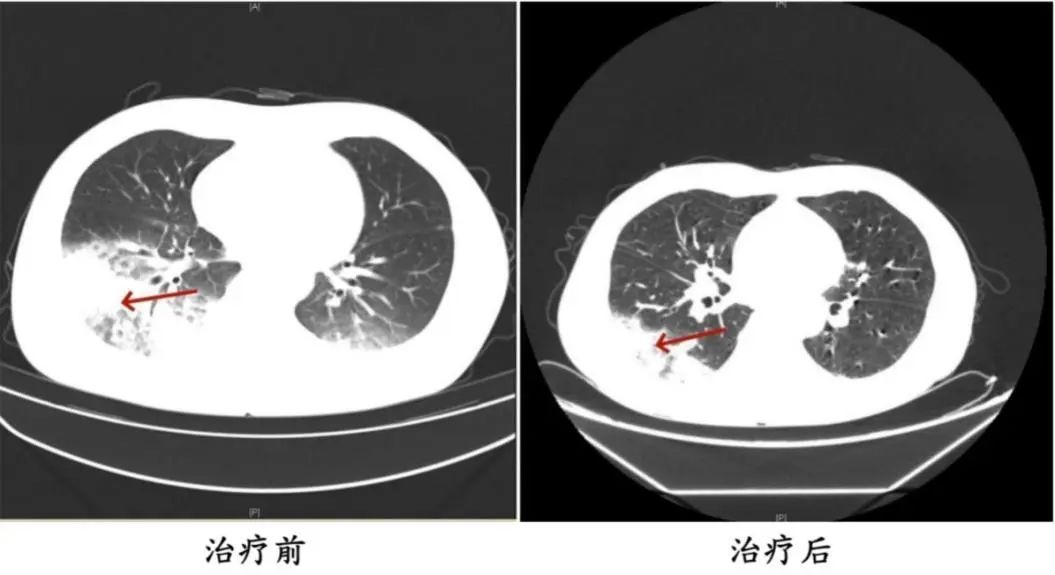 Bật điều h&ograve;a ngủ, người phụ nữ sốt cao li&ecirc;n tục, phổi tổn thương hơn một nửa: B&aacute;c sĩ cảnh b&aacute;o mối nguy &iacute;t ai ngờ ngay trong nh&agrave;- Ảnh 2.