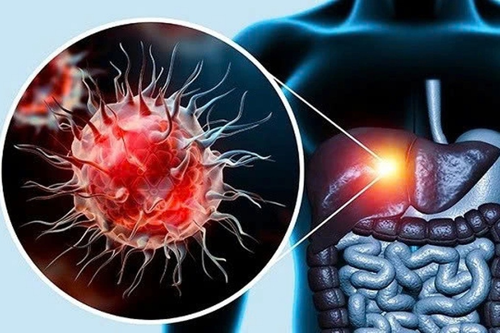 Kh&ocirc;ng rượu bia, gan vẫn c&oacute; thể tổn thương nặng v&igrave; l&yacute; do &iacute;t ai ngờ - Ảnh 1.