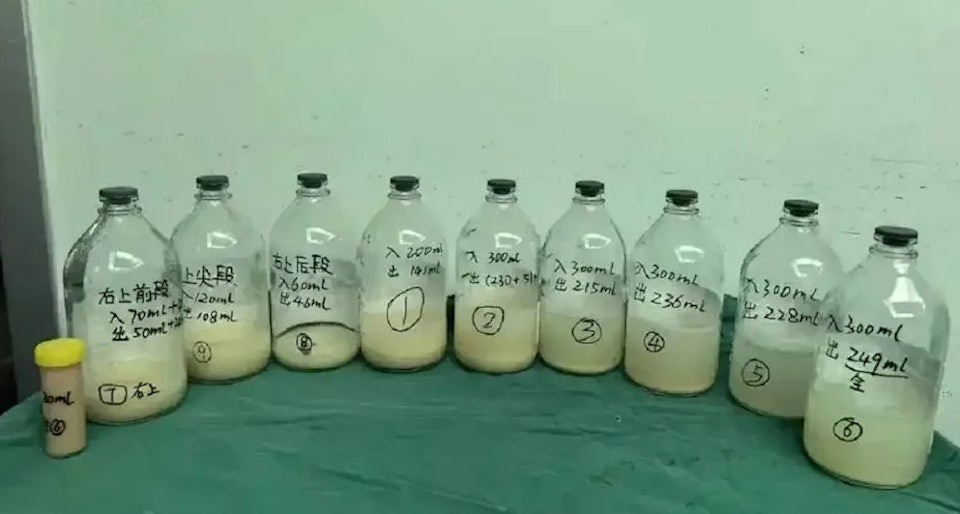 B&eacute; g&aacute;i 6 tuổi ho suốt 2 th&aacute;ng, phổi chứa đầy dịch trắng như sữa: B&aacute;c sĩ l&ecirc;n tiếng cảnh b&aacute;o- Ảnh 1.