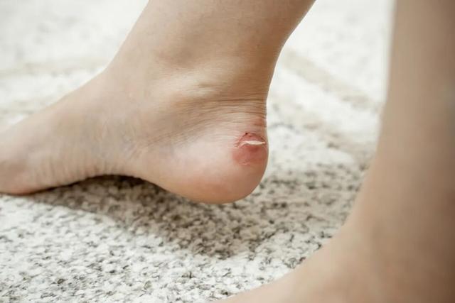 B&eacute; g&aacute;i sốt 39,3 độ C suốt 2 ng&agrave;y, nhập viện mới ph&aacute;t hiện thủ phạm l&agrave; 1 miếng băng c&aacute; nh&acirc;n- Ảnh 2.