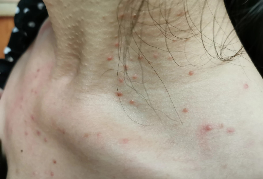 4 dấu hiệu ung thư th&iacute;ch "trốn" tr&ecirc;n v&ugrave;ng cổ- Ảnh 1.
