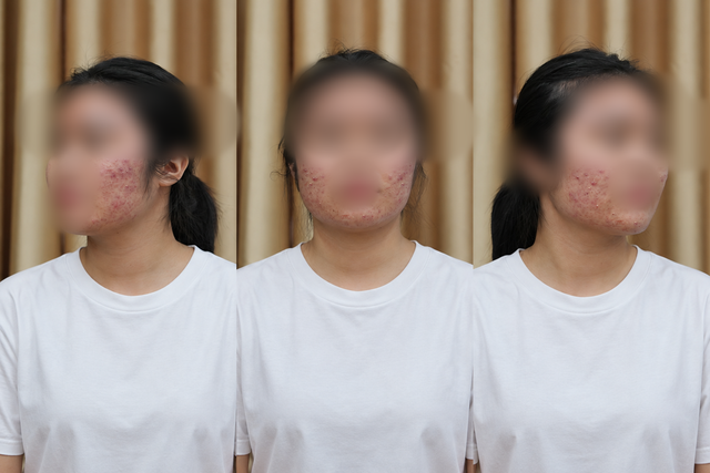 L&agrave;m đẹp cấp tốc m&ugrave;a tựu trường, nhiều nữ sinh mặt sưng như ong đốt- Ảnh 1.