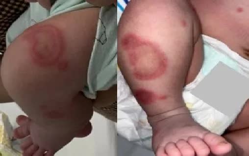 Lupus sơ sinh ở trẻ 26 ng&agrave;y tuổi, cảnh gi&aacute;c biến chứng tim - Ảnh 1.