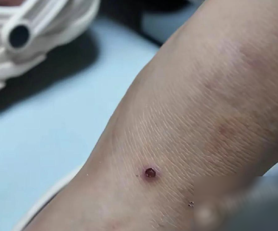 C&ocirc; g&aacute;i mọc hơn 20 nốt mụn c&oacute;c khắp cơ thể, nguồn l&acirc;y nhiễm l&agrave; nơi kh&ocirc;ng ai ngờ tới, c&oacute; người c&ograve;n tiếp x&uacute;c h&agrave;ng ng&agrave;y - Ảnh 1.