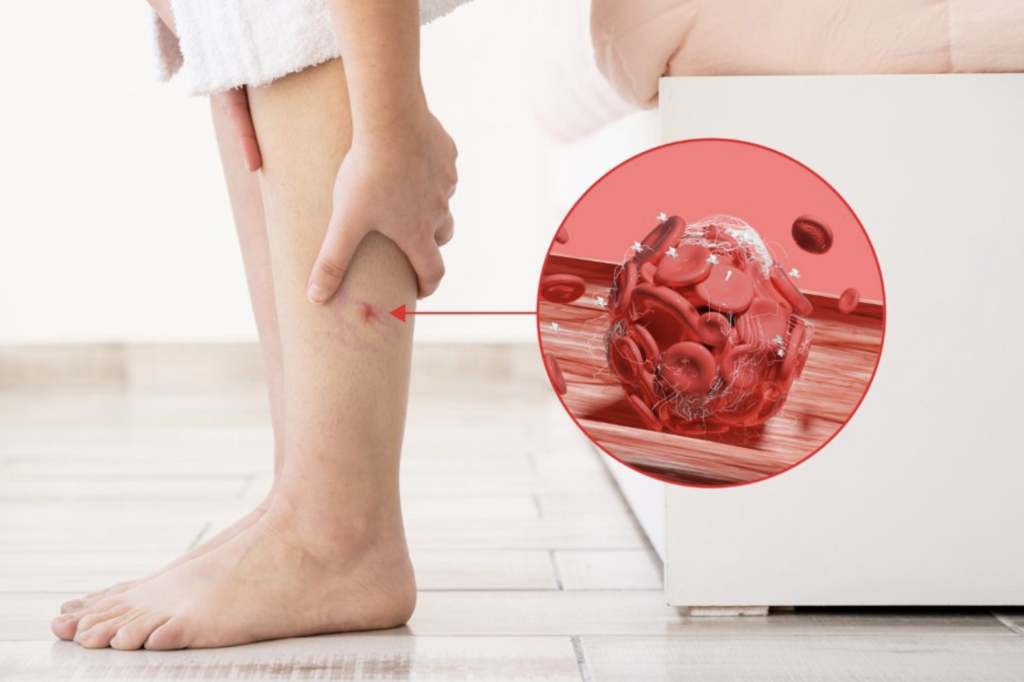 Bất kể giới t&iacute;nh, nếu điều n&agrave;y xuất hiện tr&ecirc;n ch&acirc;n, đ&oacute; c&oacute; thể l&agrave; dấu hiệu của cục m&aacute;u đ&ocirc;ng trong cơ thể- Ảnh 1.