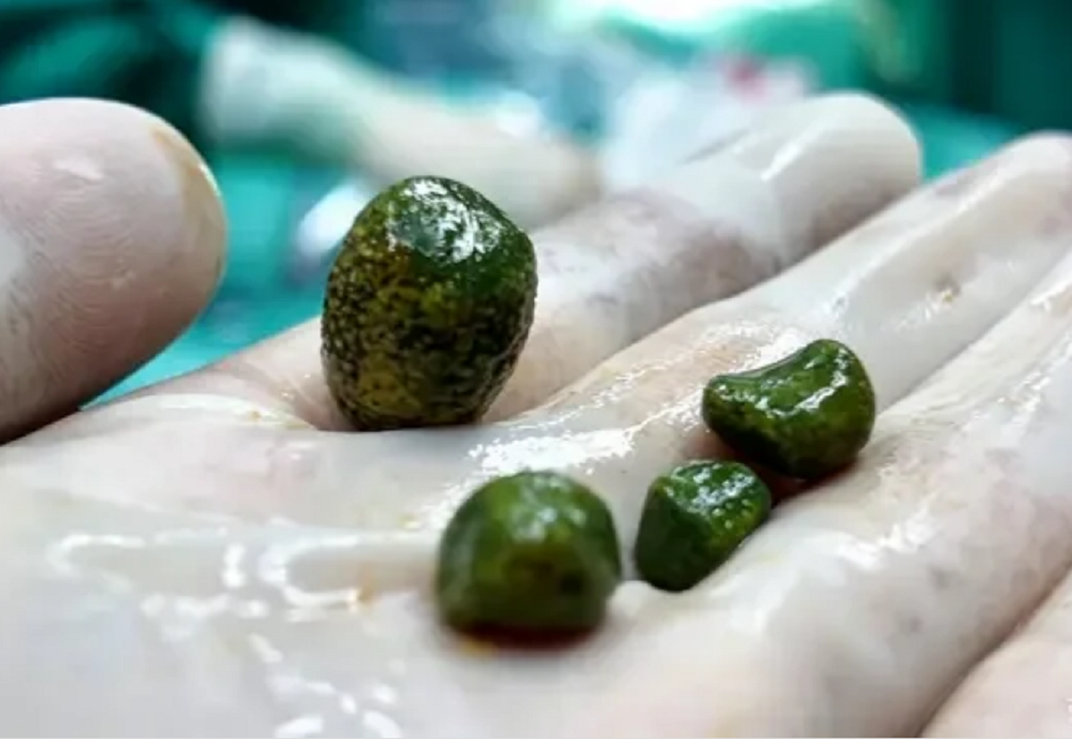C&ocirc; g&aacute;i 28 tuổi "sốc" khi b&aacute;c sĩ gắp ra thứ "nổi da g&agrave;" trong bụng m&igrave;nh- Ảnh 1.