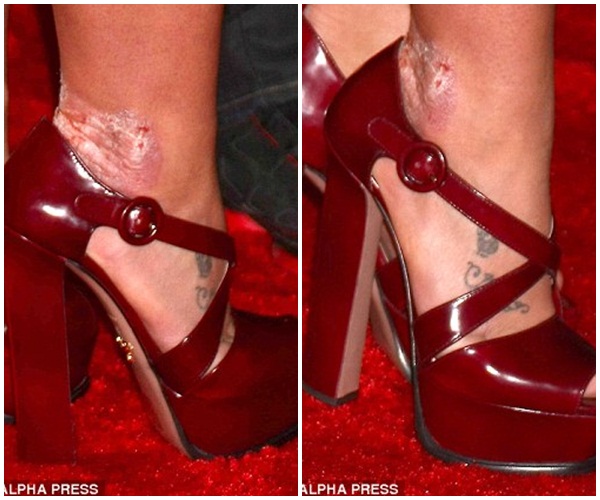 Britney lộ chân loét vảy nến nghiêm trọng 2