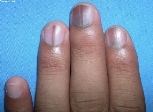 Có phương pháp điều trị nào cho ung thư hắc tố móng tay?
