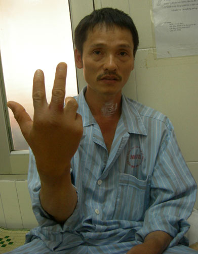 Hà Nội cũng có bệnh nhân nhập viện vì bị chuột cắn 1