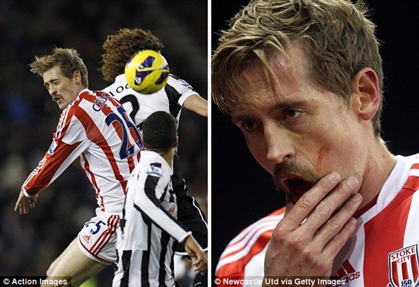 Peter Crouch bị đánh cùi chỏ gẫy răng 1