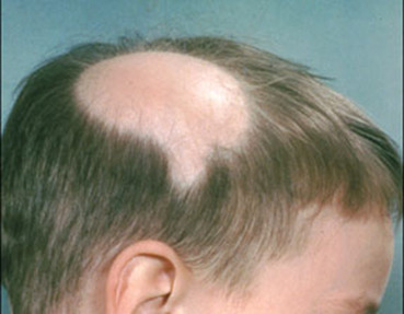 Trẻ sơ sinh rụng tóc  nguyên nhân và cách khắc phục